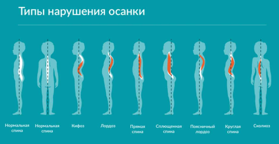 Лордоз у детей: виды, причины и лечение